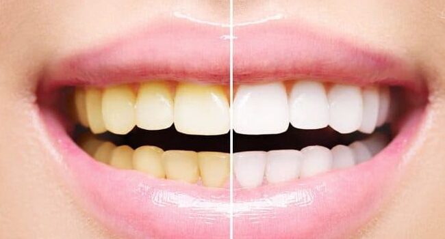 Avant après blanchiment dentaire montrant un sourire plus blanc